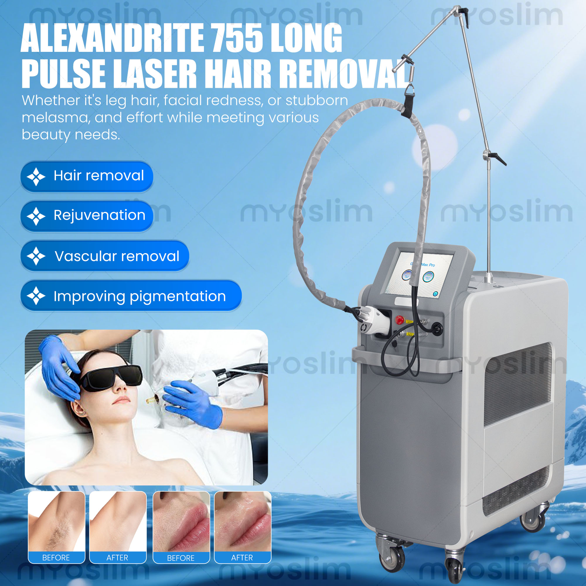 755nm 1064nm Long Pulse Alexan - огляд і ціна Alexandrite Laser Hair Removal Machine